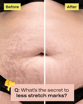 how to get rid of cellulite - Evertone Skin