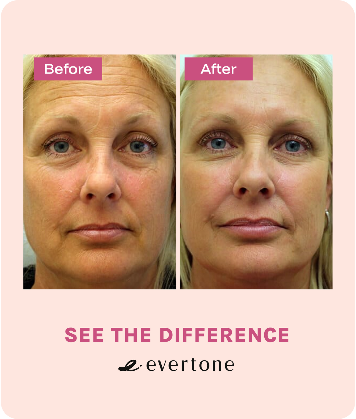 Evertone Microcurrent Facial Toning Device Evertone Skin