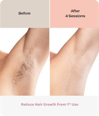 IPL Hair Laser Removal Device/EVERSMOOTH
